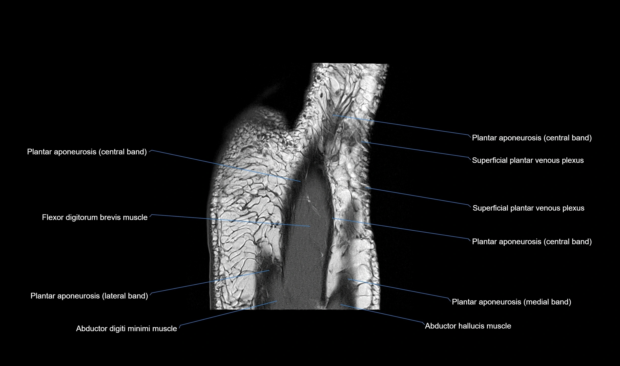 MRI mid foot coronal ligaments cross sectional anatomy 3T  radiology  image-img-00001-00038.webp